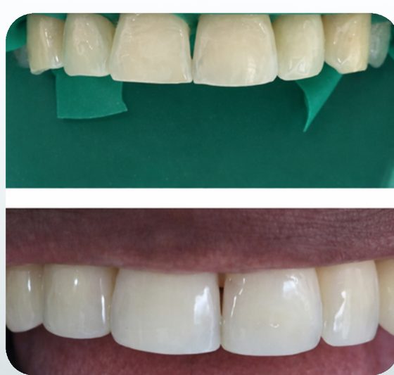 Resultado de tratamiento dental antes y después