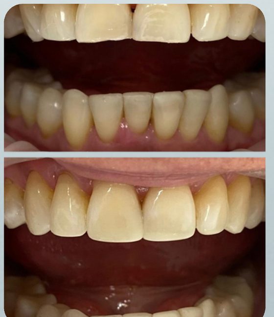 Rehabilitación dental antes y después