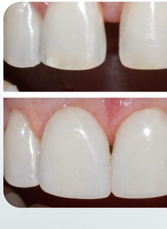 Carillas dentales antes y después