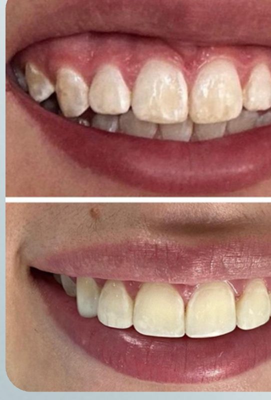 Diseño de sonrisa antes y después