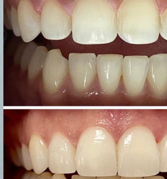 Blanqueamiento y estética antes y después